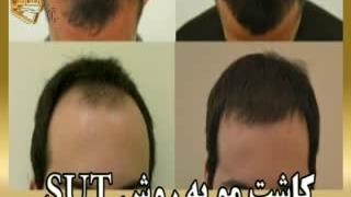 کاشت مو طبیعی با روش SUT مرکز کاشت و پیوند مو