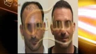 کاشت مو طبیعی با روش SUT مرکز کاشت و پیوند مو