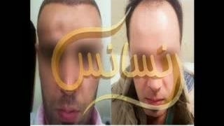 کاشت مو طبیعی با روش SUT مرکز کاشت و پیوند مو