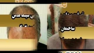 کاشت مو طبیعی با روش SUT مرکز کاشت و پیوند مو