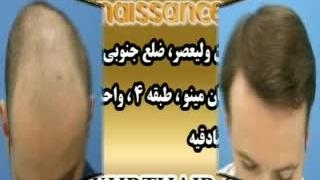 کاشت مو طبیعی با روش SUT مرکز کاشت و پیوند مو