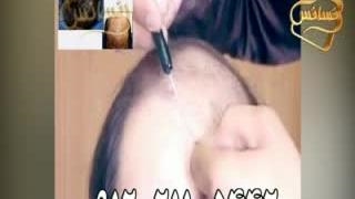 ترمیم مو با تکنیک استاندارد و انحصاری HRT مرکز مو رنسانس