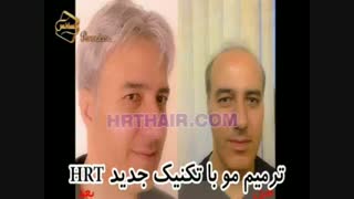 ترمیم مو با تکنیک استاندارد و انحصاری HRT مرکز مو رنسانس