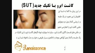 ترمیم مو به روش اختصاصی HRT مرکز تخصصی موی رنسانس