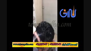 ترمیم مو گلهای تهران - کاشت مو - روش های فیکس آلمان