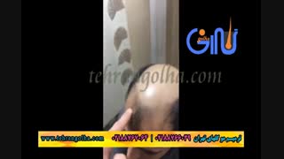 ترمیم مو گلهای تهران - کاشت مو - روش های فیکس آلمان
