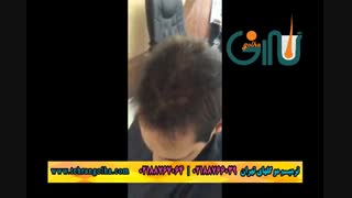 ترمیم مو گلهای تهران - کاشت مو - روش های فیکس آلمان