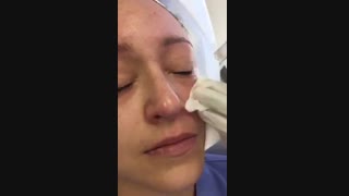 میکرونیدلینگ دورچشم