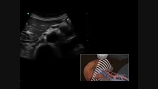 سونوگرافی کلیه