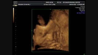 سونوگرافی سه بعدی جنین