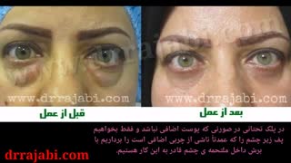 بلفاروپلاستی(جراحی زیبایی پلک)