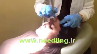 میکرونیدلینگ جوانسازی صورت