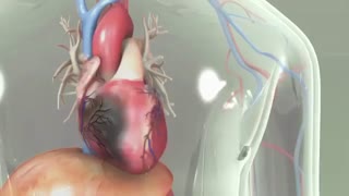 دیابت نوع دو