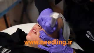 آموزش میکرونیدلینگو درماپن