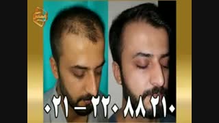کاشت مو به روش SUT مرکز تخصصی مو رنسانس
