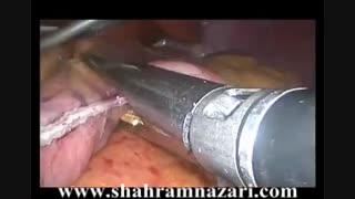 اسلیو معده جهت لاغری(توسط دکتر شهرام نظری جراح چاقی) پروتز سینه