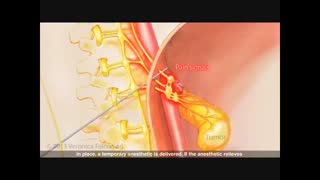 بلوک شبکه سلیاک، درمانی برای کاهش دردهای سرطانی شکم