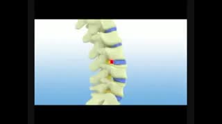 جراحی لیزری دیسک کمر- دکتر علی نقره کار