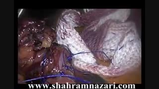 مینی بای پاس معده (لوپ بای پاس معده) در درمان چاقی