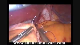 اسلیو گاسترکتومی جهت لاغری(دکتر شهرام نظری جراح چاقی) کلینیک زیبایی