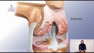 نلا آرترو ( روغن ماساژ مفاصل ) ضد آرتروز